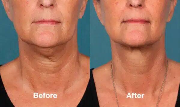 Kybella Before & After Image