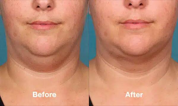 Kybella Before & After Image