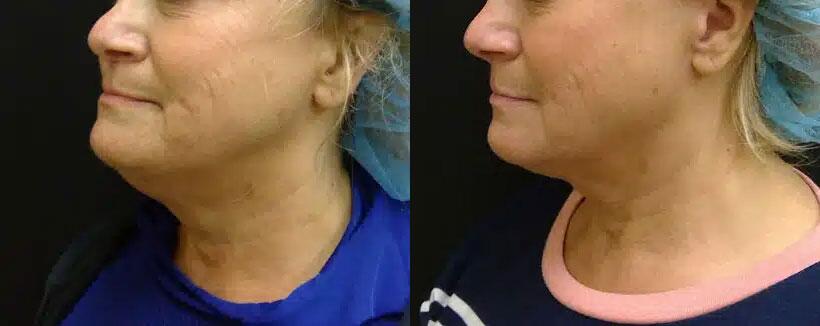 Kybella Before & After Image