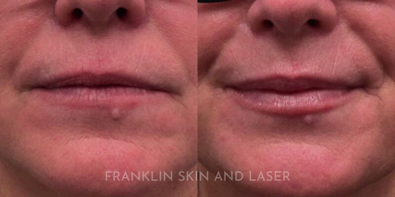 lip filler Before & After Image