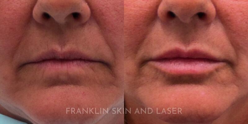 lip filler Before & After Image