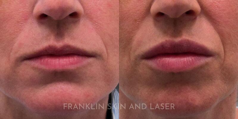 lip filler Before & After Image