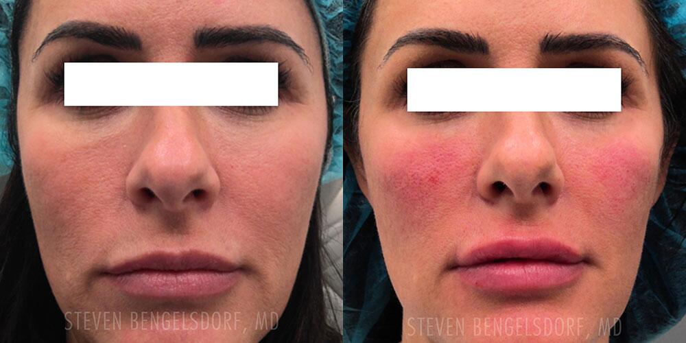 lip filler Before & After Image