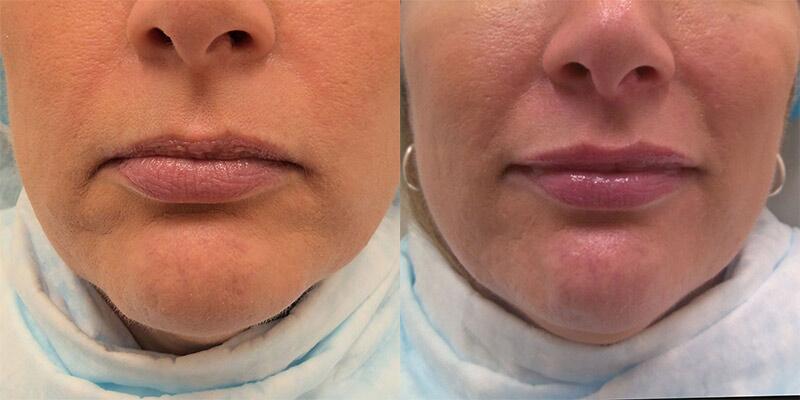 lip filler Before & After Image