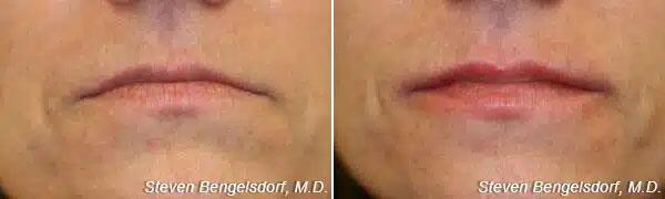 lip filler Before & After Image