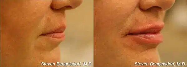 lip filler Before & After Image