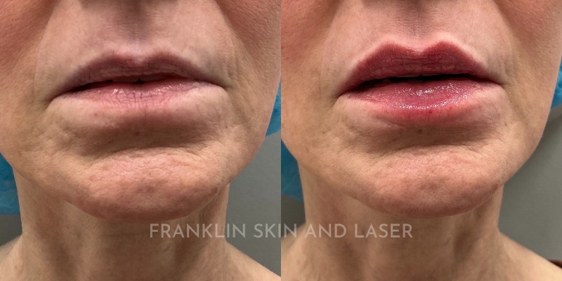 Lip Filler Before & After Image