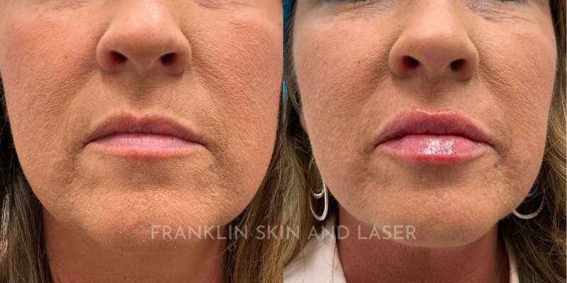 Lip Filler Before & After Image