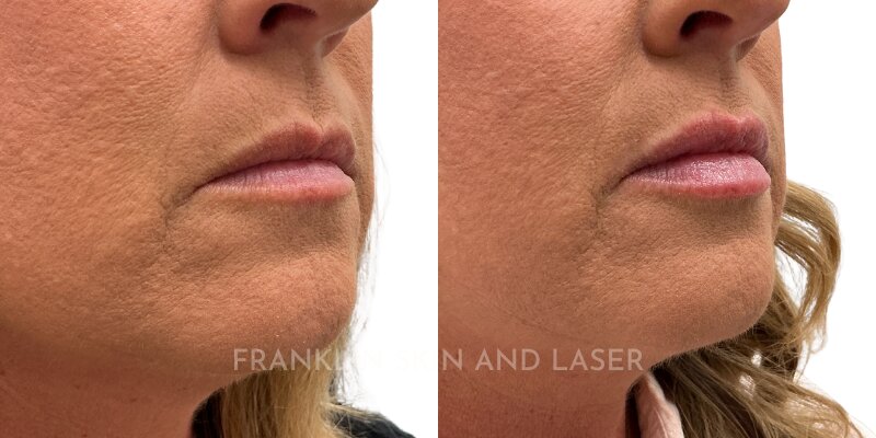 Lip Filler Before & After Image