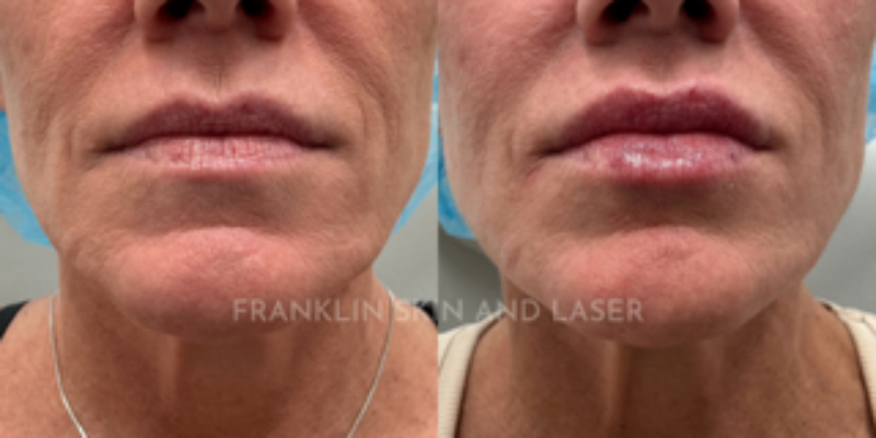 Lip Filler Before & After Image