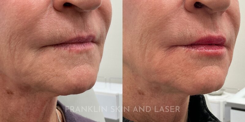 Lip Filler Before & After Image