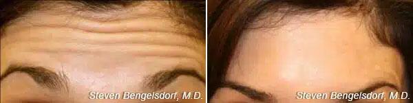 Neuromodulators Before & After Image