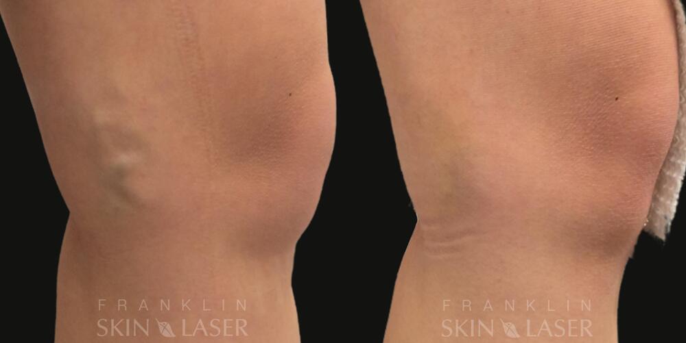 Sclerotherapy Before & After Image