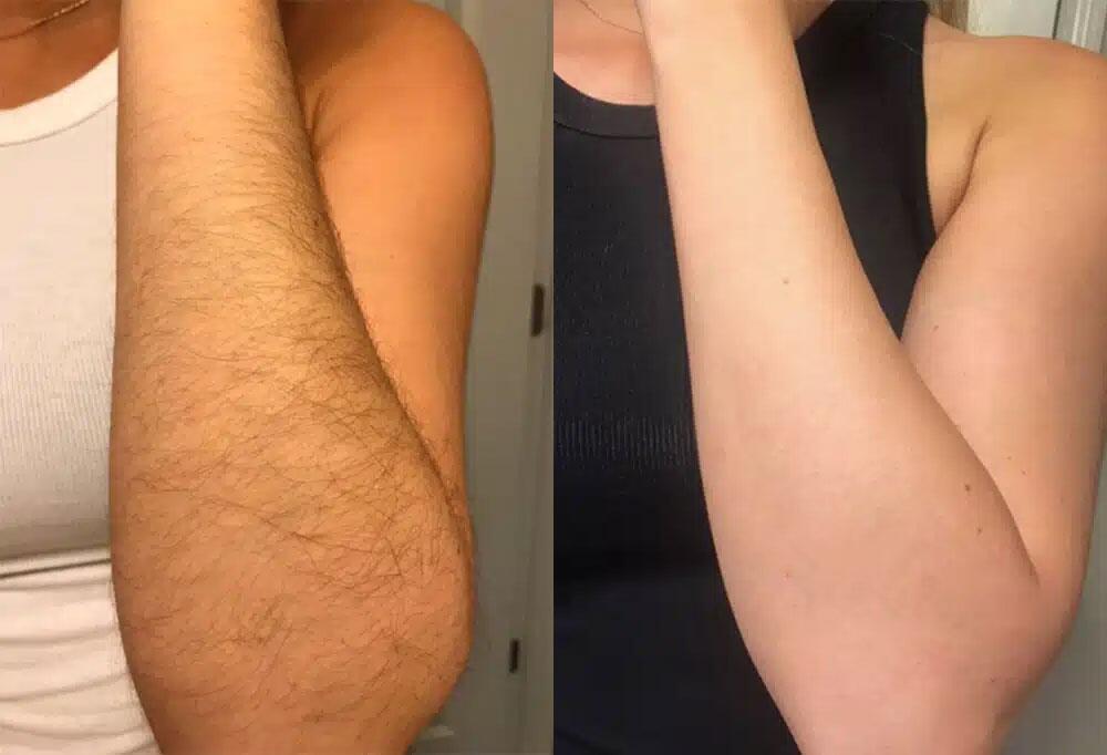 Laser Hair Removal Before & After Image