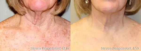 photorejuvenation Before & After Image