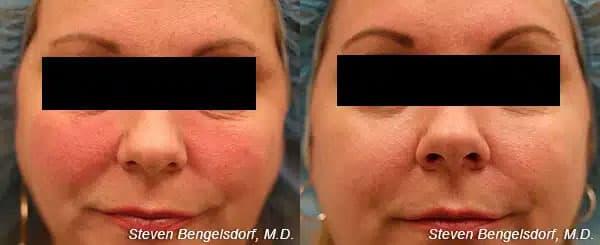 photorejuvenation Before & After Image