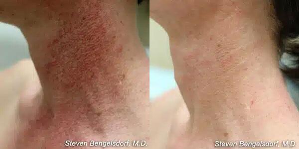 photorejuvenation Before & After Image