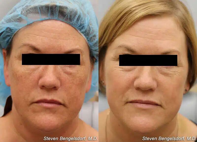 photorejuvenation Before & After Image