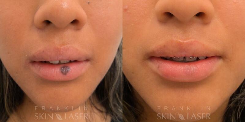 Photorejuvenation Before & After Image