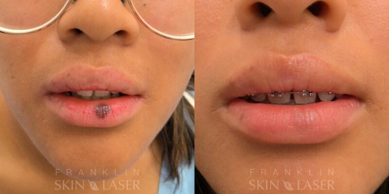 Photorejuvenation Before & After Image