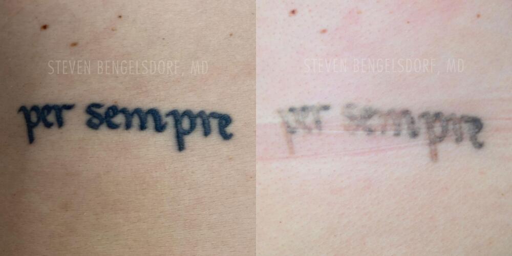 tattoo removal Before & After Image