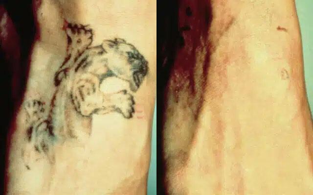 tattoo removal Before & After Image