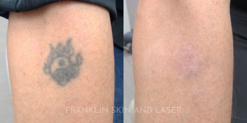Tattoo Removal Before & After Image
