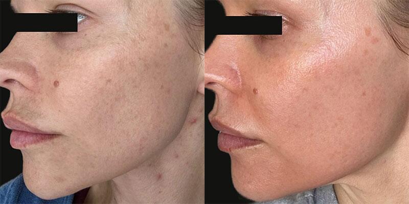 ultraclear Before & After Image