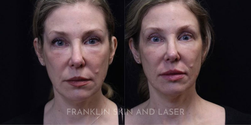 ultraclear Before & After Image