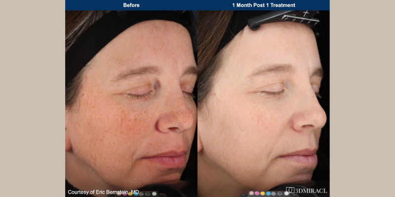 ultraclear Before & After Image