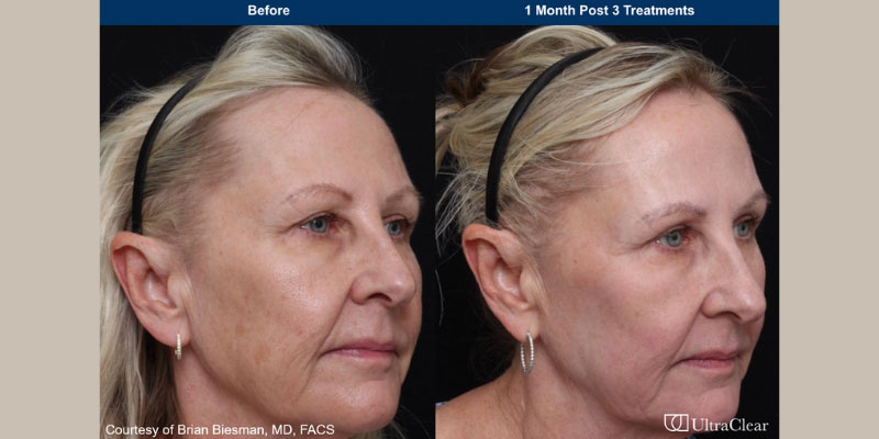 ultraclear Before & After Image