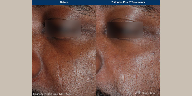 ultraclear Before & After Image