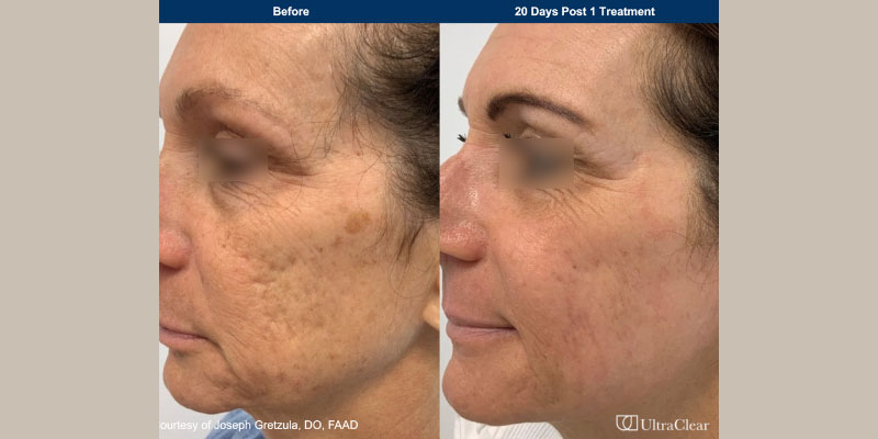 ultraclear Before & After Image